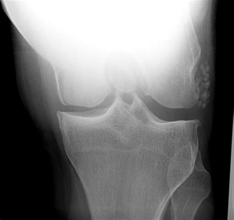Short description: Displaced oblique <strong>fracture</strong> of shaft of <strong>left</strong> femur, init; The 2024 edition of <strong>ICD</strong>-<strong>10</strong>-CM S72. . Fracture left knee icd 10